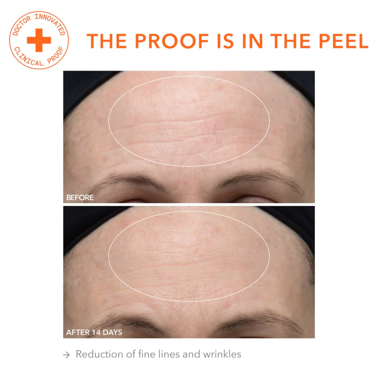 Dr. Dennis Gross Alpha Beta Ultra Gentle Daily Peel: for Dehydrated or Sensitive Skin, Uneven Tone or Texture, Fine Lines or Enlarged Pores (30 Treatments)