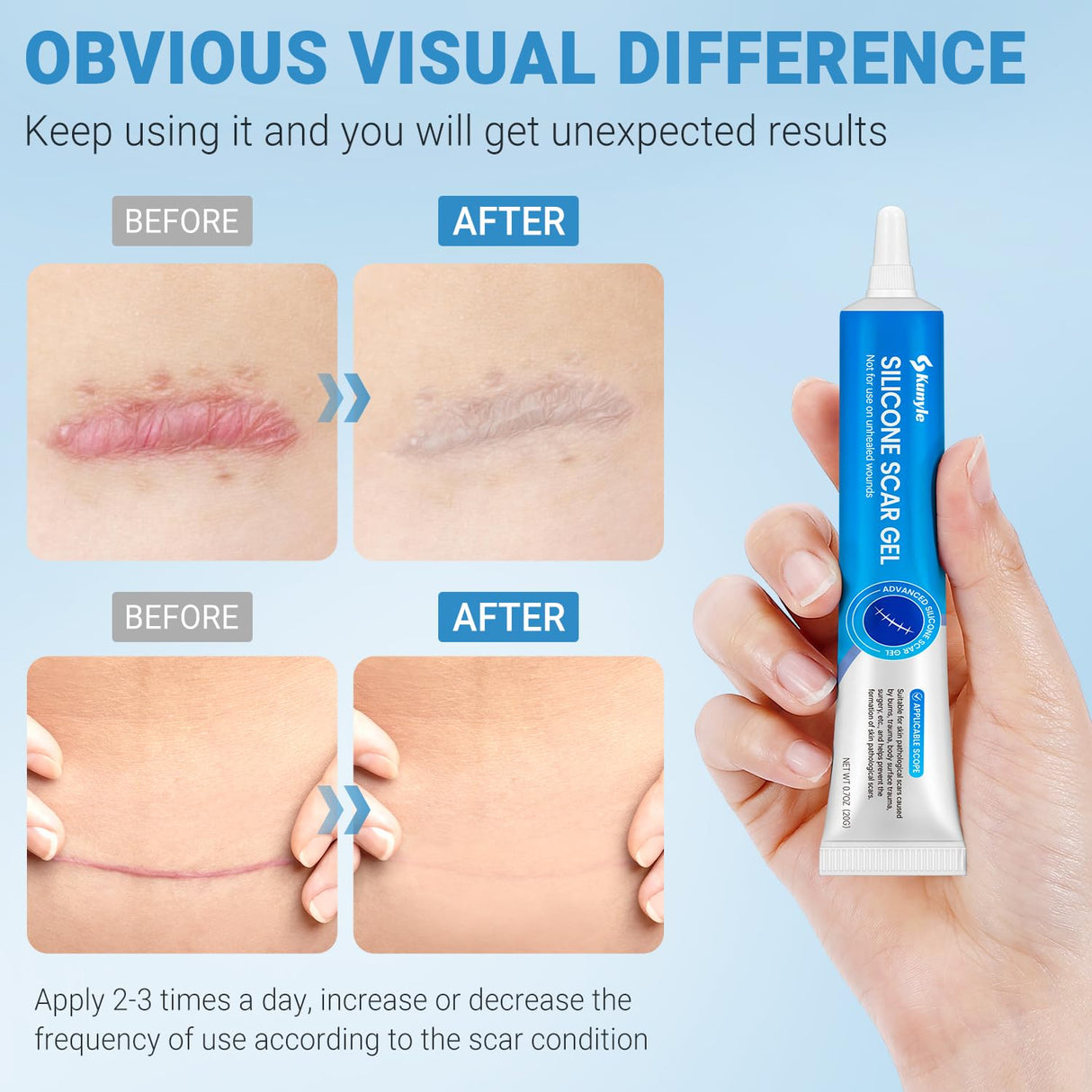Kunyle Silicone Scar Gel, Scar Cream, Advanced Scar Gel for Surgical Scars, Stretch Marks, Keloid Bump Removal, Old and New Scars 0.70oz (20g)