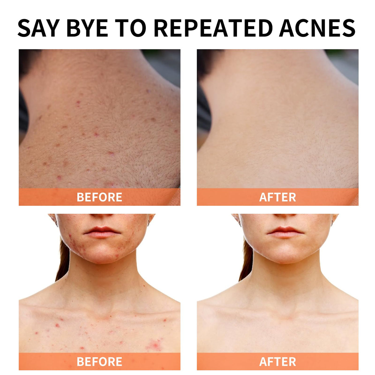 Acne Treatment for Face for Hormonal Cystic Stubborn Acne Cream for Sensitive Skin Teens Adults Women Men Spot Pimple Butt Control Rapid Clearing Breakout Overnight Face Blemish Treatment Moisturizer