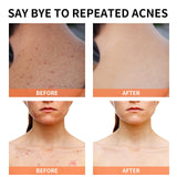 Acne Treatment for Face for Hormonal Cystic Stubborn Acne Cream for Sensitive Skin Teens Adults Women Men Spot Pimple Butt Control Rapid Clearing Breakout Overnight Face Blemish Treatment Moisturizer