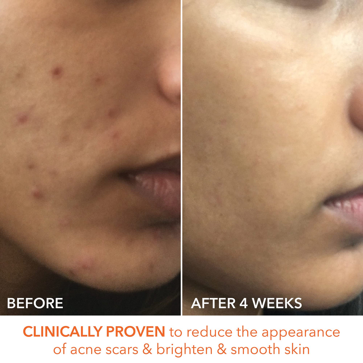 Dr. Dennis Gross Alpha Beta Extra Strength Daily Peel: for Oily Skin, Uneven Tone or Texture, Wrinkles or Enlarged Pores (30 Treatments)