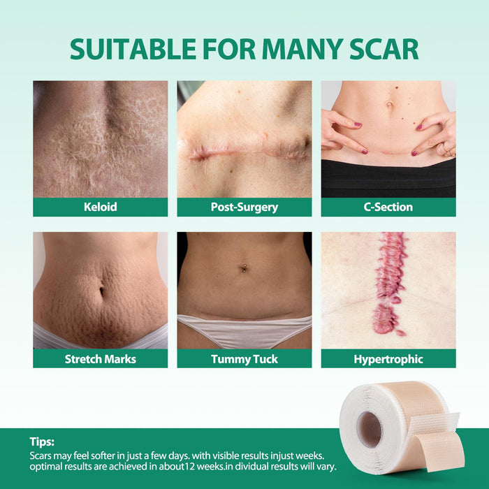 Medical Grade Silicone Scar Sheets (1.6” x 120” Roll - 3M), Professional Silicone Scar Tape, Reusable Silicone Scar Strips, Scar Remove Treatment for Acne Scars C-Section & Keloid Surgery