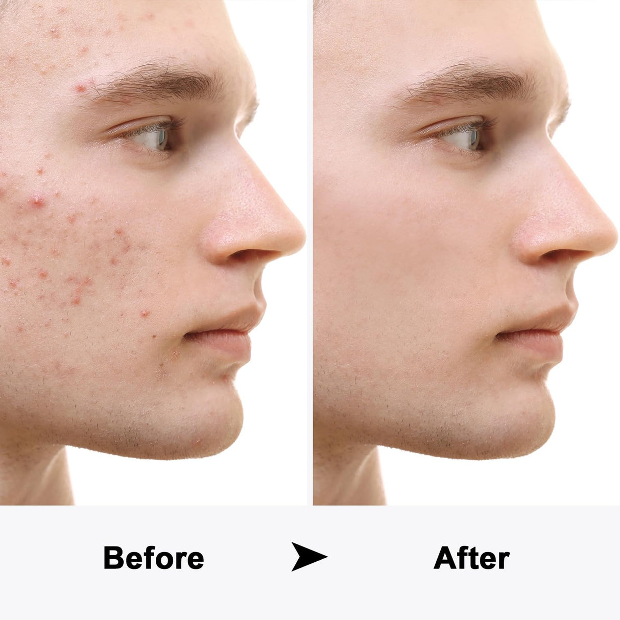 Cosprain LED Acne Foe - Acne Spot Pimple Zit Treatment Device Red and Blue Light Therapy for Face, Facial Aesthetic Device, Blue