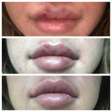 BruiseMD Arnica 1,000mg and Bromelain 500mg 2,400GDU/g Supplement for Bruising and Swelling, easy to swallow capsules (7-Day Supply)