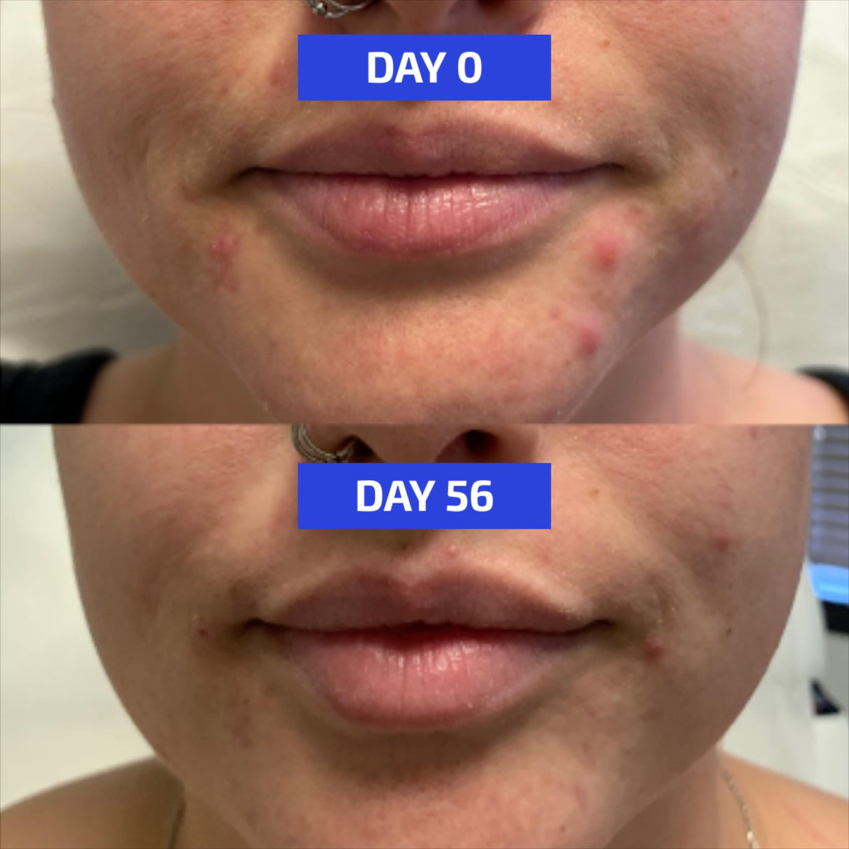 Codex Labs Shaant Clear Skin Supplement – 60 Vegan Capsules | Acne Probiotics with 9-Strain Blend, Green Tea EGCG & Guggul – Daily Support for Acne-Prone Skin & Clear Complexion