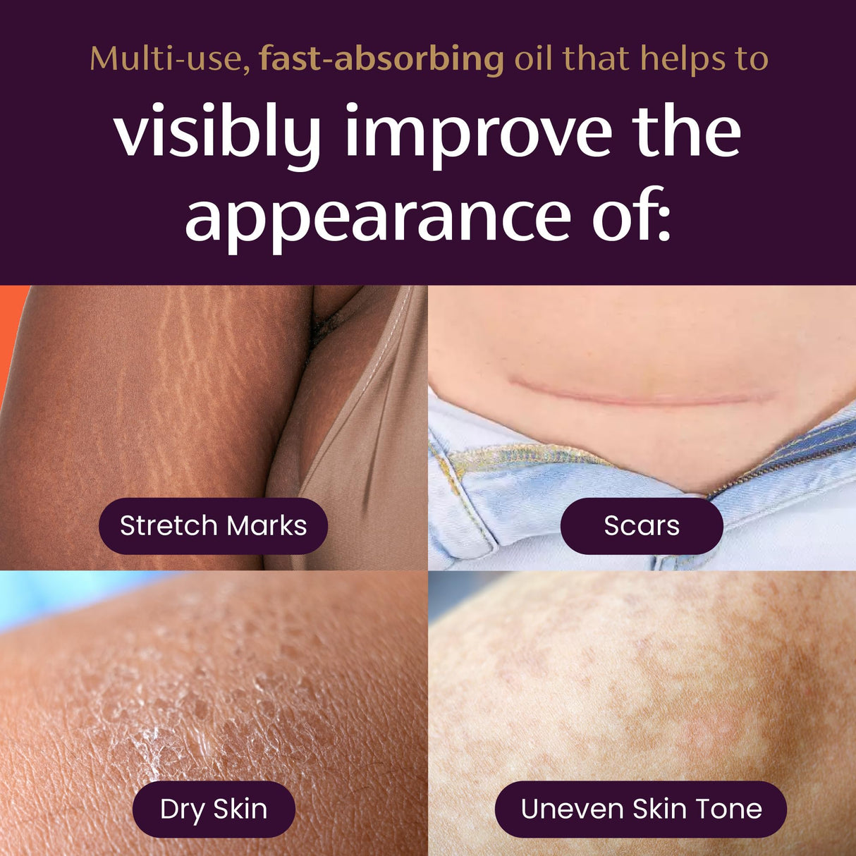 Mederma Quick Dry Oil, Scar and Stretch Mark Treatment, Helps to Improve the Appearance of Scars and Stretch Marks, with Natural Botanical Extracts, Paraben Free, Fast-Absorbing, 2.02oz (60ml)