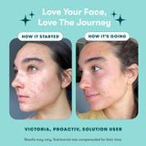 Proactiv Solution Acne Treatment Kit, Original 3-Step Face Routine, 30-Day