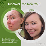 Exposed Skin Care Acne Treatment Kit - Includes Facial Cleanser, Clearing Tonic, Acne Treatment Serum, Clear Pore Serum, Clarifying Mask, Cloth - Natural Acne Solution for Face, All Ages & Skin Types