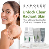 Exposed Skin Care Acne Treatment Kit - Includes Facial Cleanser, Clearing Tonic, Acne Treatment Serum, Clear Pore Serum, Clarifying Mask, Cloth - Natural Acne Solution for Face, All Ages & Skin Types