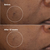 Clinique Even Better Clinical Brightening Moisturizer With Salicylic Acid, Glucosamine + Vitamin C | Hydrating + Dark Spot Reducing, 1.7 Ounce