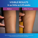 ScarAway Silicone Scar Gel, Helps Improve Size, Color & Texture of Hypertrophic & Keloid Scars from Injury, Burns & Surgery, Water Resistant, 20g (0.7 Oz)