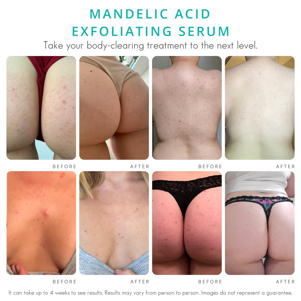 Almond Clear Level 2 Serum | Mandelic Acid Body Serum for Acne, Folliculitis, Aging Skin, Ingrown Hairs, Dark Spots on Face, Chest, Butt, Back, Thighs, Arms | 4 oz