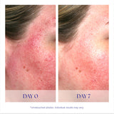 iS Clinical Pro-Heal Serum Advance+ antioxidant-rich serum containing vitamin C, E, and A for redness, rosacea, inflammation, 0.5 Fl Oz