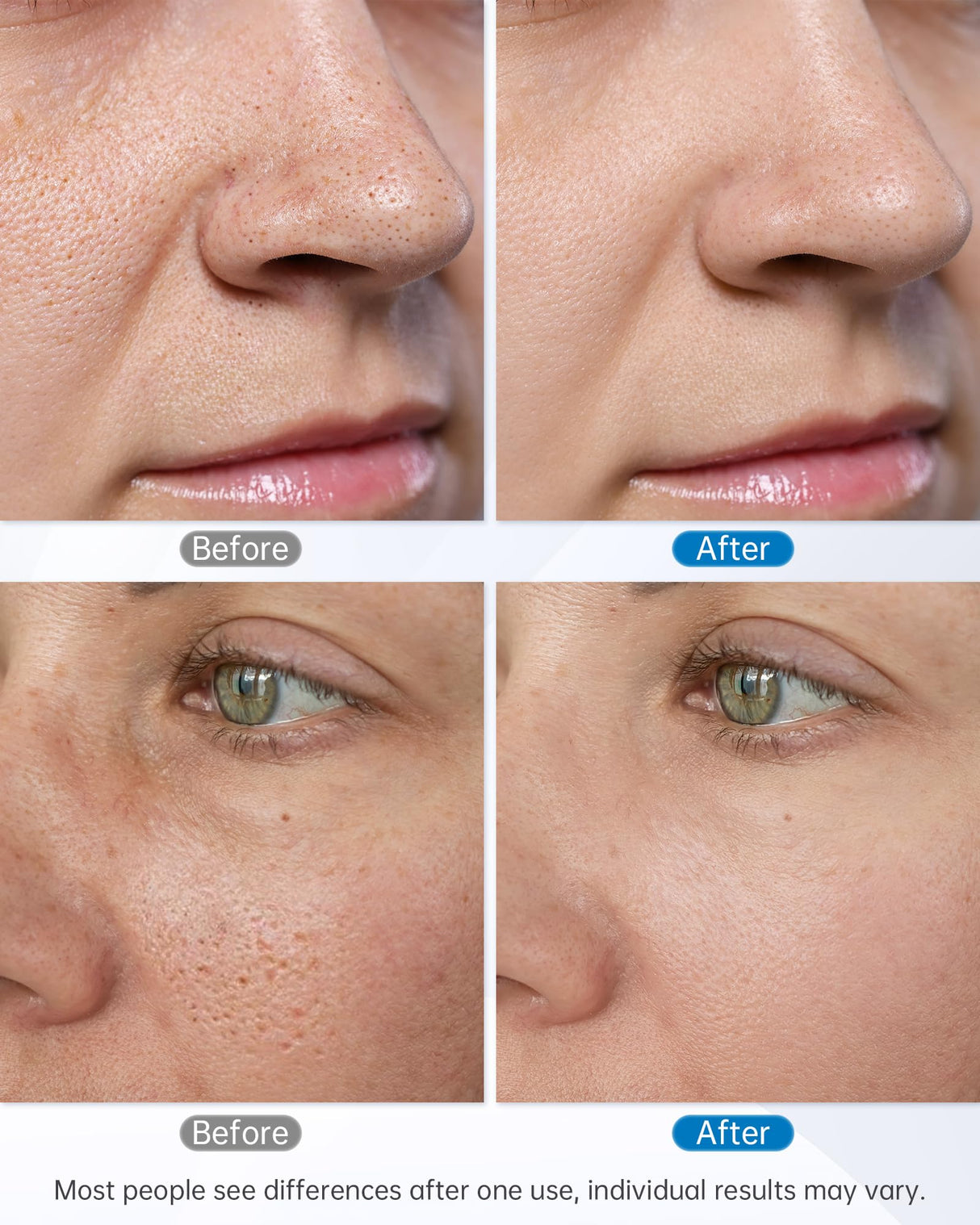 At-home Microdermabrasion Machine, UNOISETION 2 in 1 Dermabrasion Facial Machine for Exfoliation & Blackhead Removal, Diamond Micro Dermabrasion for Skin Care, Beauty Gifts for Women, White