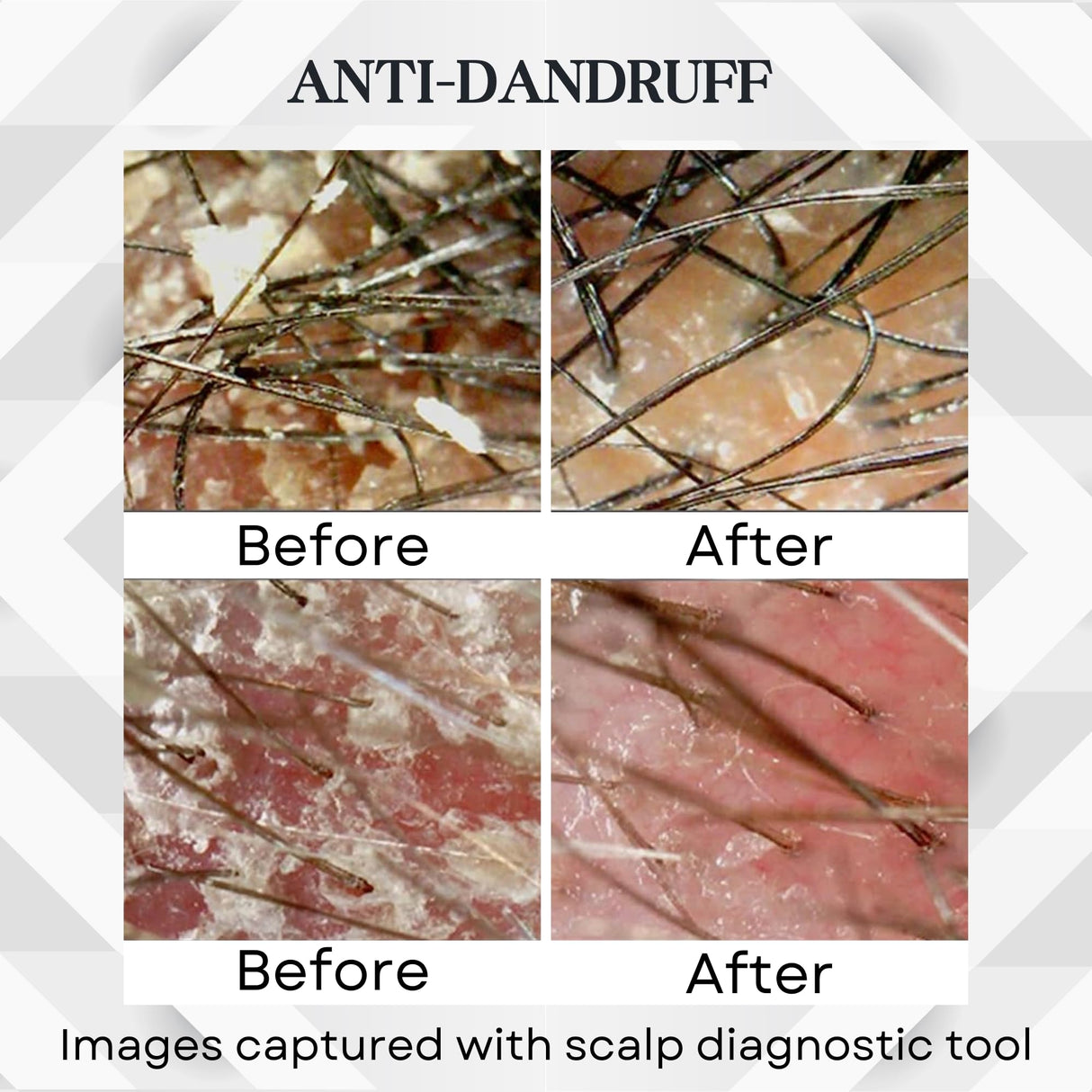 ABERA Amanda Anti-Dandruff Shampoo for Stronger Hair & Healthier Scalp, Nourishes, Get Rid of Dandruff