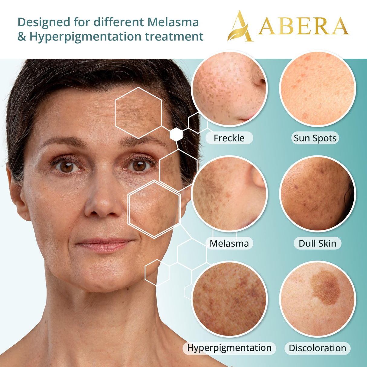 Abera Melasma Serum Plus, Melasma Treatment for Face, Dark Spot Corrector Serum, Melasma Dark Spot Remover, Sun Spot, Age Spot, Brown Spot Remover for Men, Women (1 FL OZ)