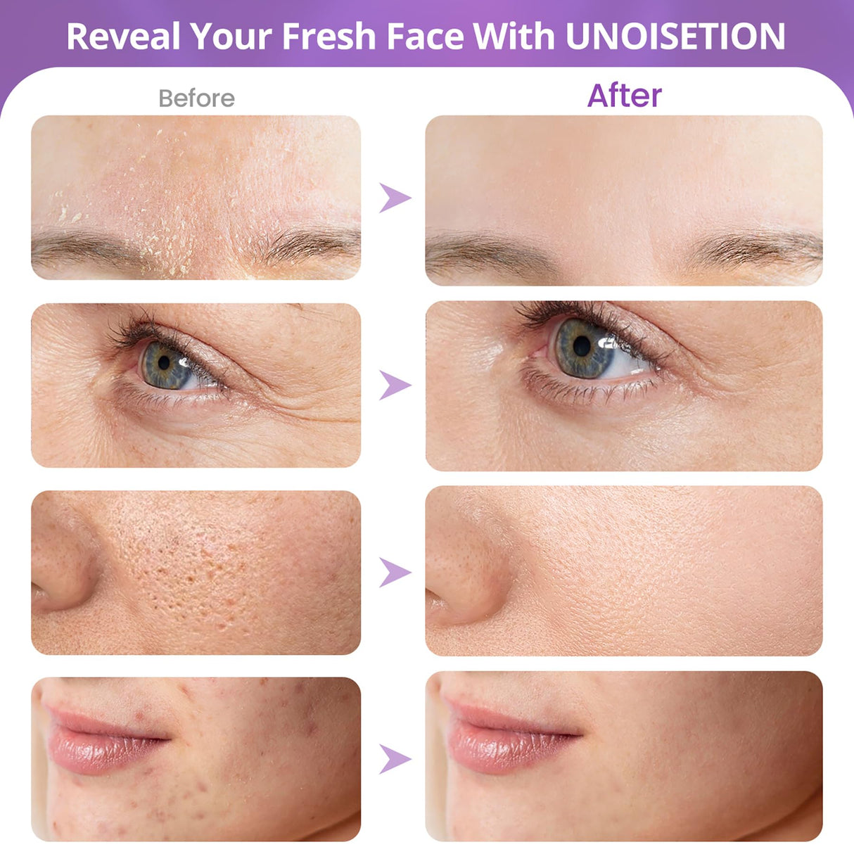 Diamond Microdermabrasion Machine, UNOISETION 3 in 1 Dermabrasion Facial Machine for Exfoliation & Blackhead Removal, Home Use Facial Skin Care Device