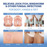 Hermon Antifungal Soap with Tea Tree Oil: Antifungal Bar Soothing Care & Relief of Itchy for Ringworm Jock Itch Tinea Versicolor Athletes Foot - Body & Face Wash