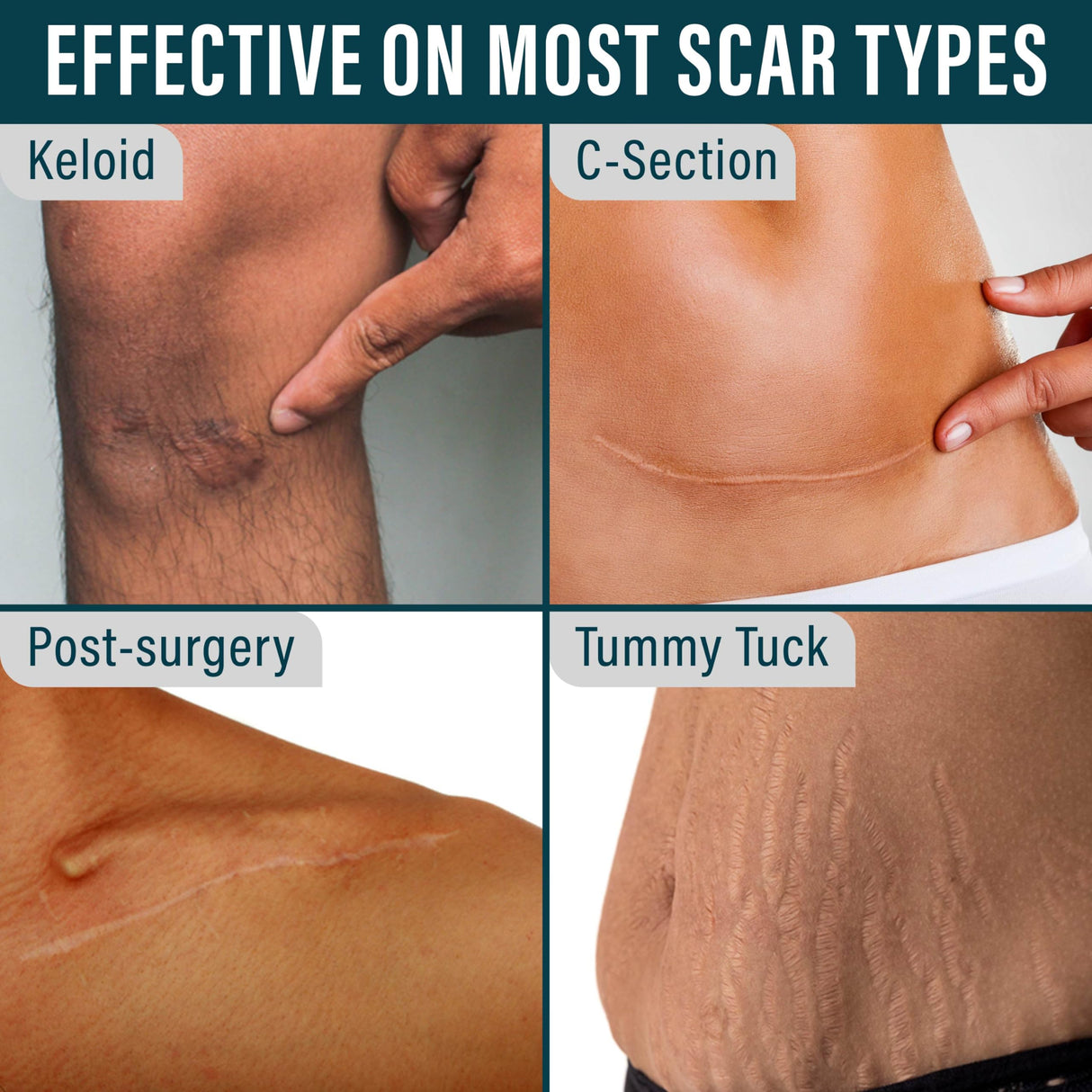 NUVADERMIS Silicone Scar Tape for Surgical Scars - 120" x 1.5" Roll - Extra Long Medical Grade Silicone Scar Tape for C-Section, Tummy Tuck, Keloid, and Surgical Scars - Reusable Tape Strips - 2 Pack