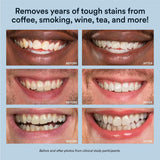 Auraglow Teeth Whitening Kit, LED Accelerator Light, 35% Carbamide Peroxide Teeth Whitening Gel, 20+ Whitening Treatments, Whitens up to 10 Shades in 7 Days