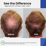 C’rcle Men's Minoxidil 5% Foam - 6 Month Supply - Helps Restore Vertex Hair Loss & Thinning Hair - Extra Strength Supports Hair Regrowth for Men, Unscented Hair Loss Treatments for Men