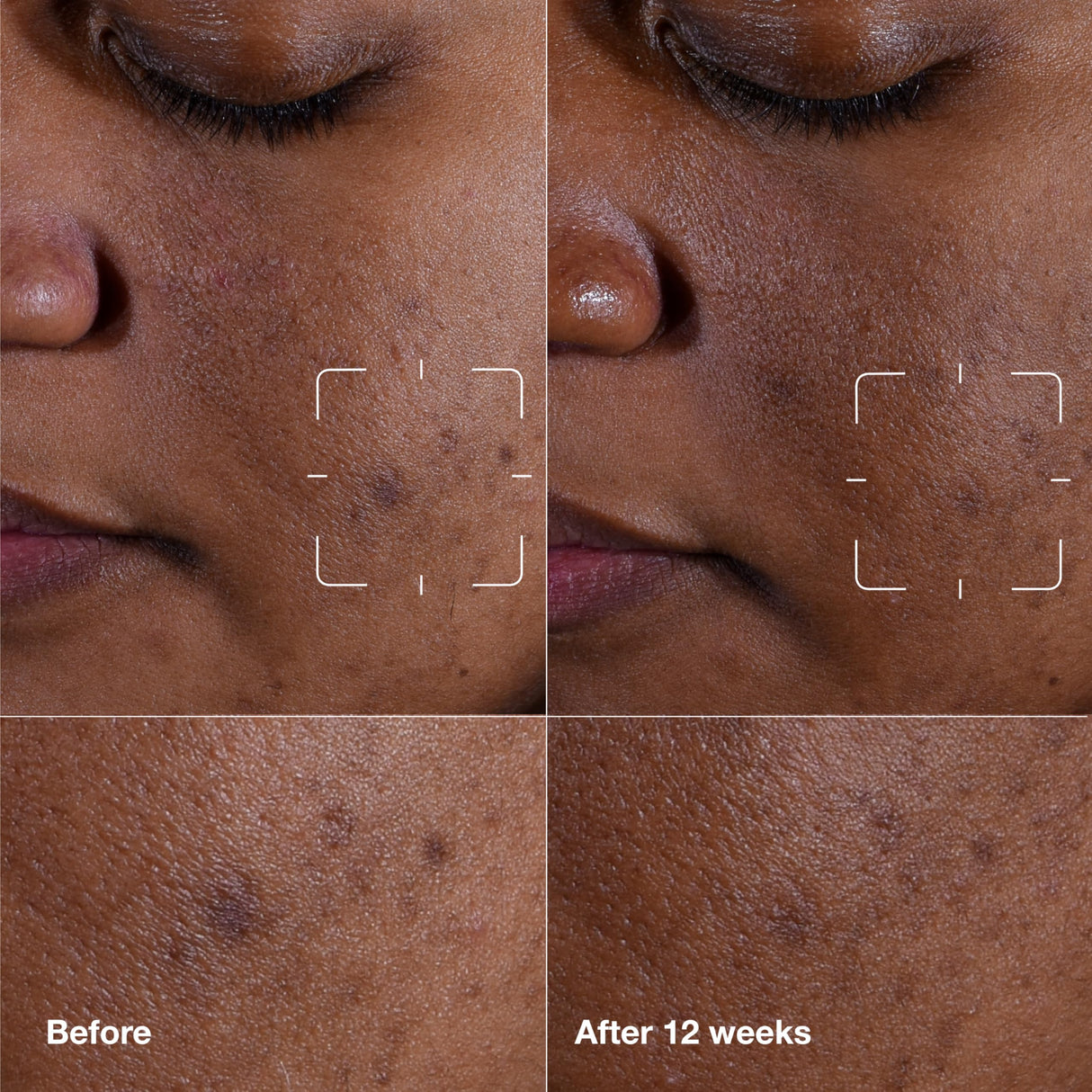 Clinique Even Better Clinical Dark Spot Clearing Serum With Vitamin C | Brightening + Soothing, 2.5 Fl Oz