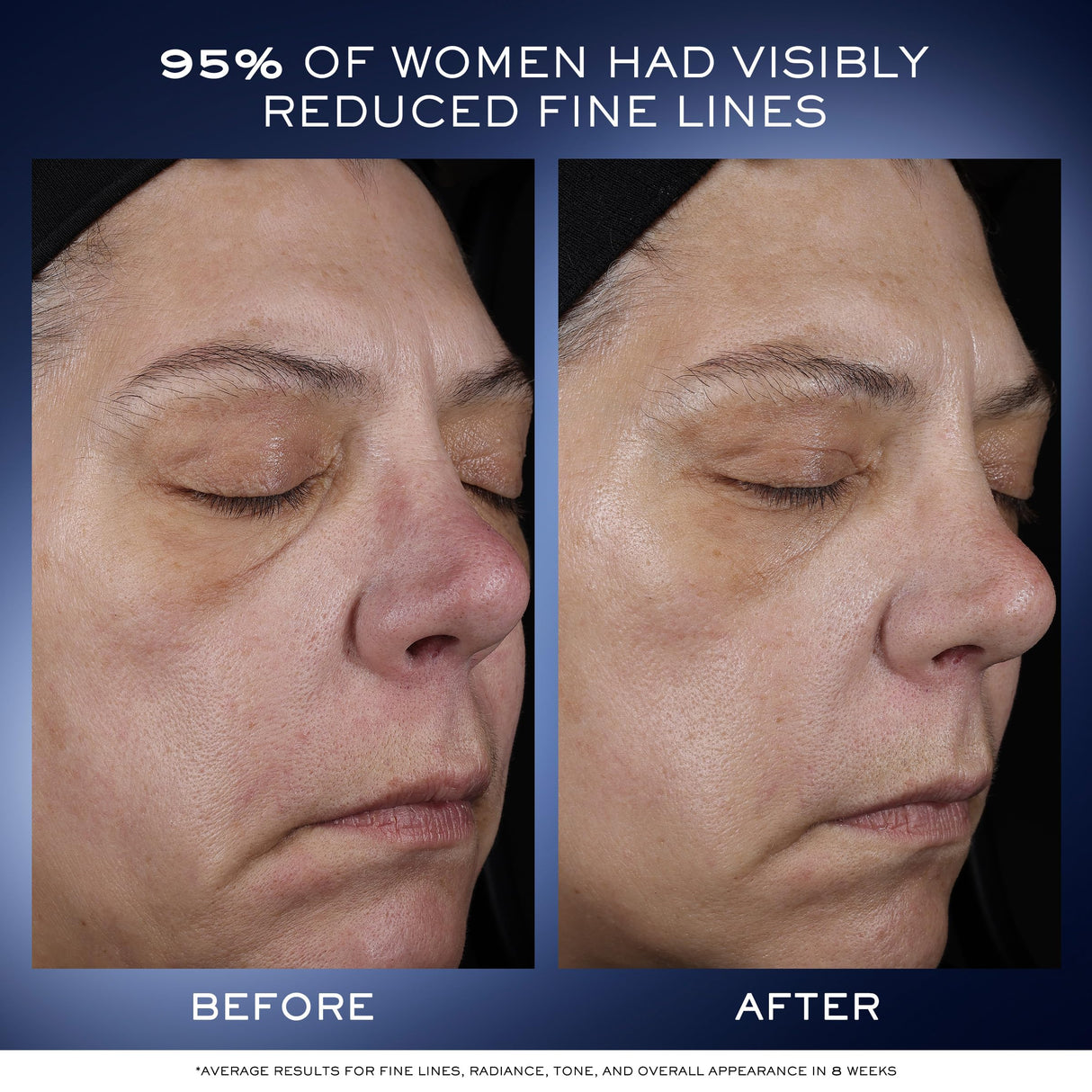 Lancôme Génifique Ultimate Dual Recovery Face Serum - Visibly Improves Fine Lines, Rough Texture, Plumpness and Even Skintone - with Beta Glucan and, Hyaluronic Acid - 1.69 Fl Oz