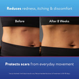 ScarAway Silicone Scar Gel, Helps Improve Size, Color & Texture of Hypertrophic & Keloid Scars from Injury, Burns & Surgery, Water Resistant, 20g (0.7 Oz)