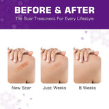 Kelinul Silicone Scar Sheets(1.6 x 120"Roll-3M) Scar Removal Silicone Scar Tape for Softening and Flattening Scars, Acne, C-Section, Keloid Surgery, Painless Removal, Reusable, Washable, 10-12 Month Supply
