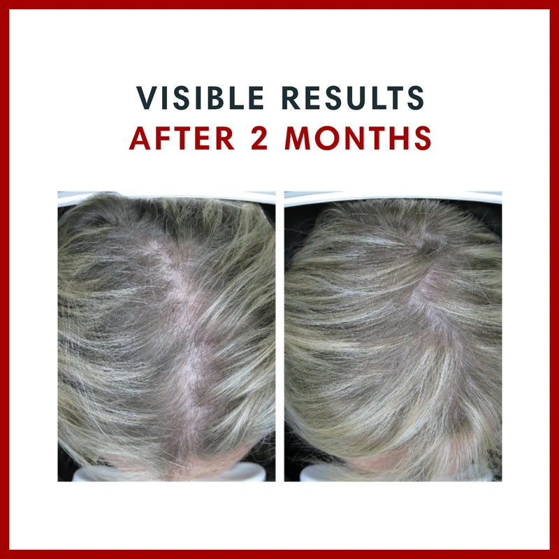 Consult Health BIOTIN GAIN- Biotin Rich Gummies with Patented ANAGAIN - for Gorgeous Thicker Looking Hair