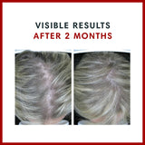 Consult Health BIOTIN GAIN- Biotin Rich Gummies with Patented ANAGAIN - for Gorgeous Thicker Looking Hair