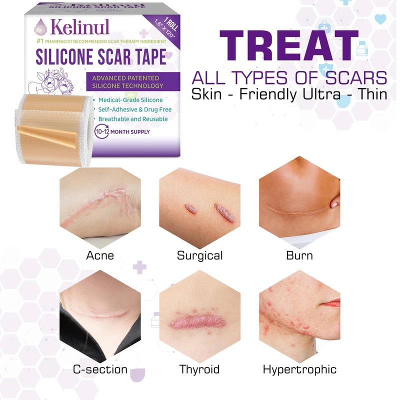 Kelinul Silicone Scar Sheets(1.6 x 120"Roll-3M) Scar Removal Silicone Scar Tape for Softening and Flattening Scars, Acne, C-Section, Keloid Surgery, Painless Removal, Reusable, Washable, 10-12 Month Supply