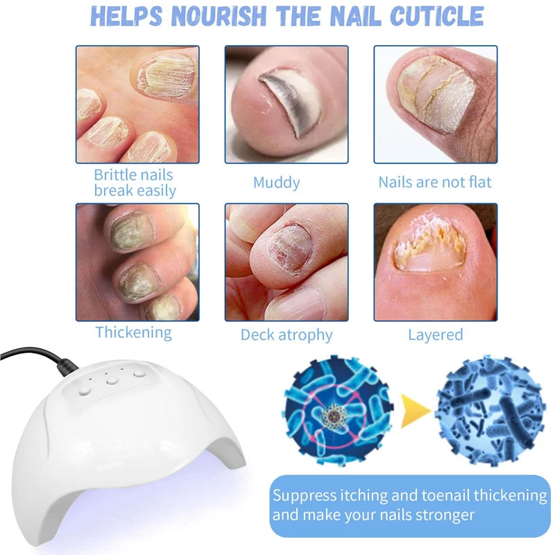 Light Therapy Nail Fungus Laser Device Against Nail Fungus, Laser Nail Fungus Remover, Rechargeable Portable Pure Nail Laser, Pure Nail Fungus Laser Therapy Device, Nail Fungus Treatment Quick