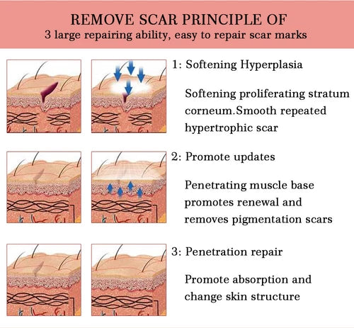 Yoxier Lavender Scar Repair Cream Anti Stretch Marks Cream Scar Removal Cream