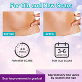 Kelinul Silicone Scar Sheets(1.6 x 120"Roll-3M) Scar Removal Silicone Scar Tape for S...