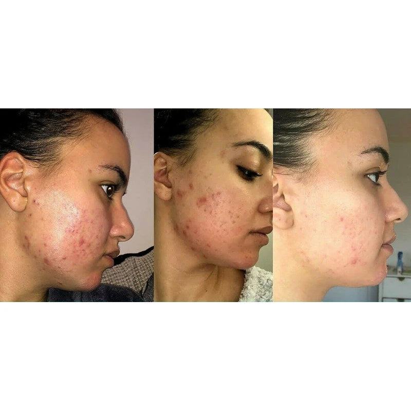 Retinol Gel 0.1 Vitamin A Repairs Fine Lines & Wrinkles, Scar Treatment, Age and Sun Spots, Anti-Aging Formula , 20 Grams